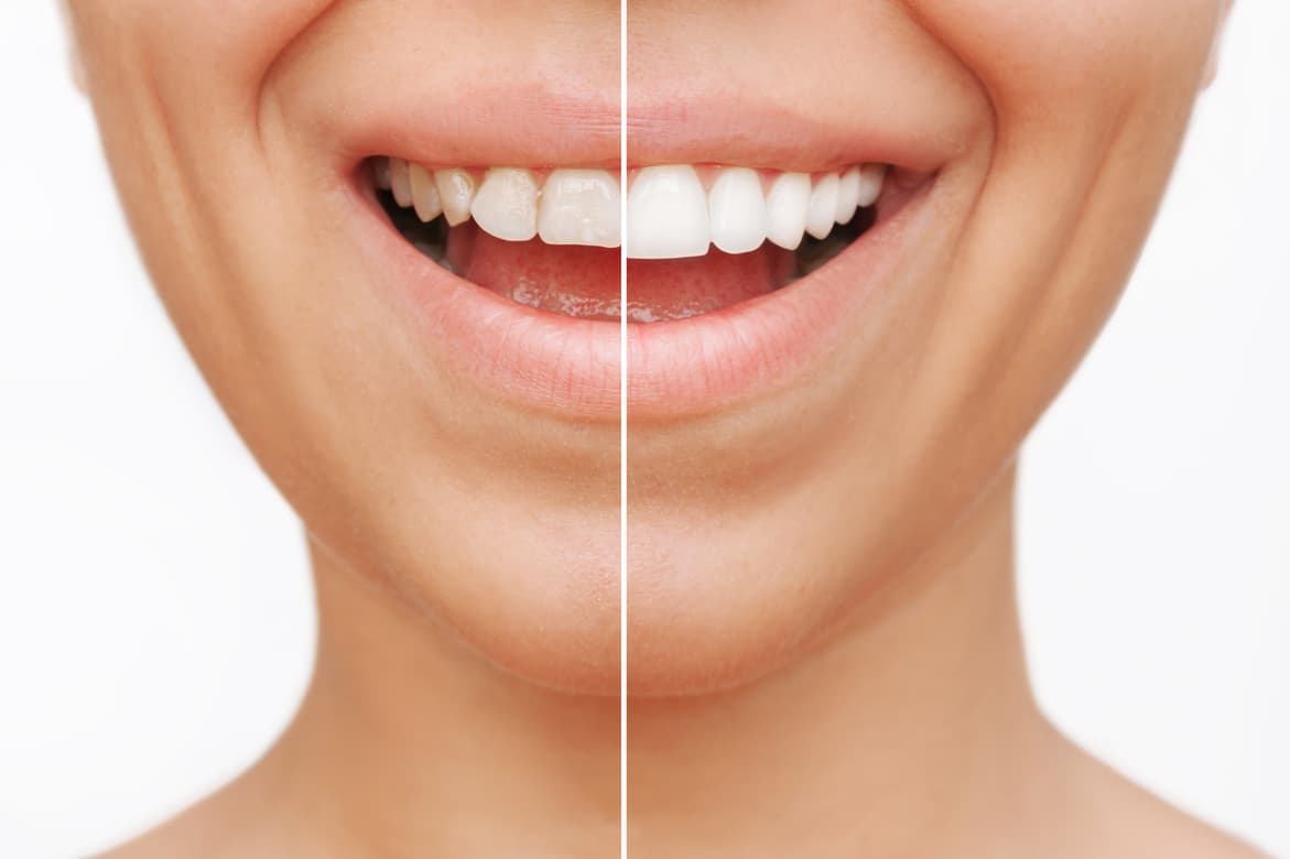 Full Smile Makeover