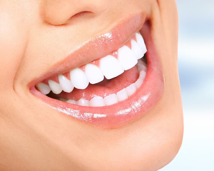 Teeth Whitening